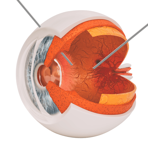 유리체 절제술 (Vitrectomy)