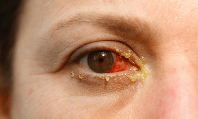 심한 충혈과 눈곱(분비물)
