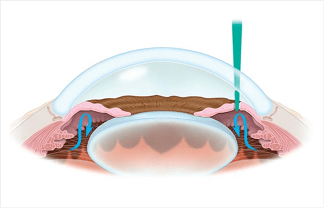 레이저 홍채 절개술