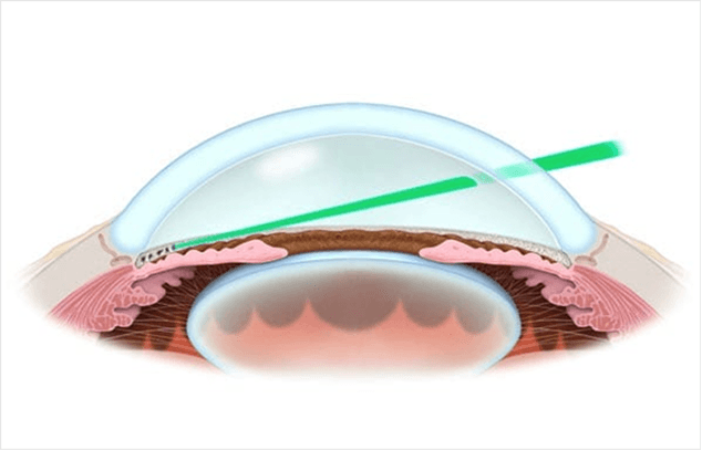 선택적 레이저 섬유주 성형술