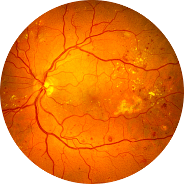 비증식성 당뇨망막병증