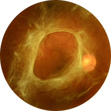 견인성 망막박리