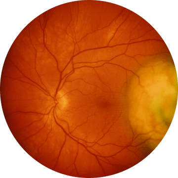 삼출성 망막박리