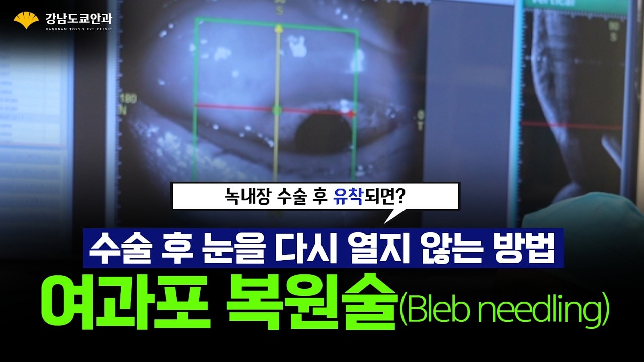 녹내장재수술 후 눈을 다시 열지 않는 여과포복원술