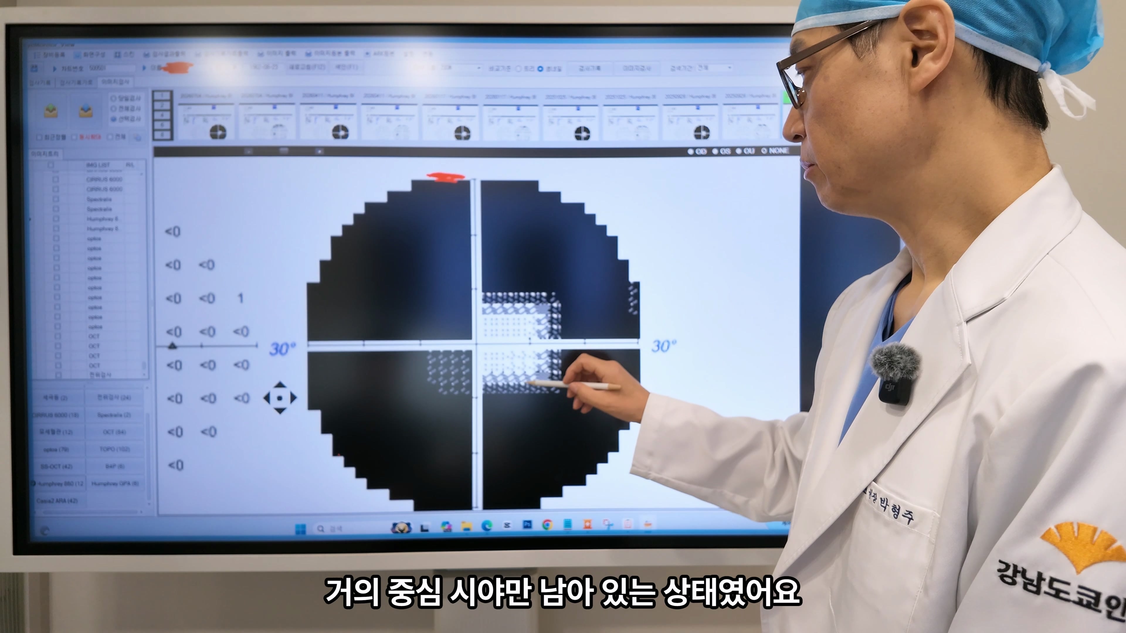 60대 초반 녹내장 우안 터널시야, 섬유주절제술과 수술 후 경과 확인