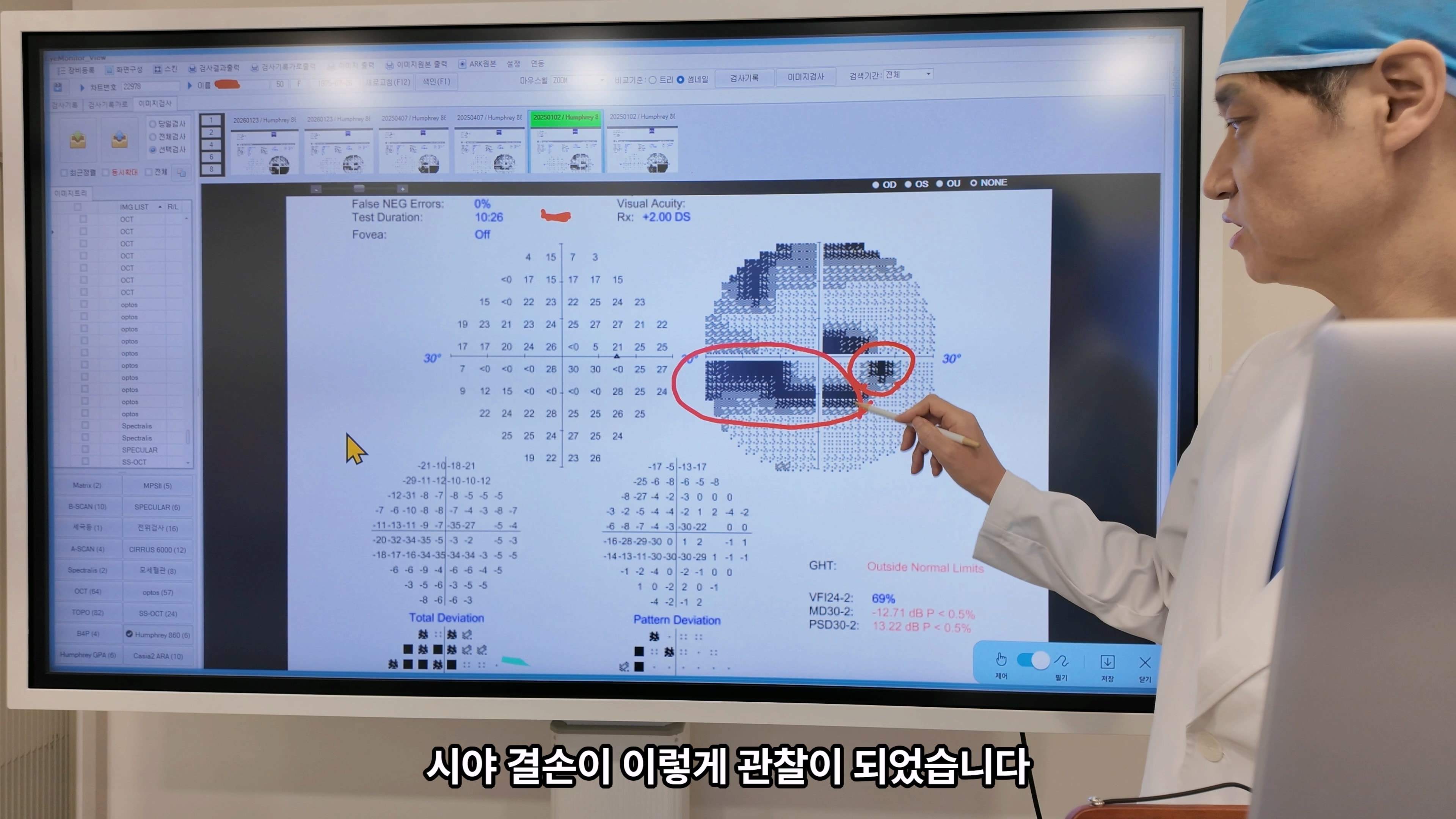 50대초반 녹내장, 우안녹내장수술을 고려해야 했던 이유