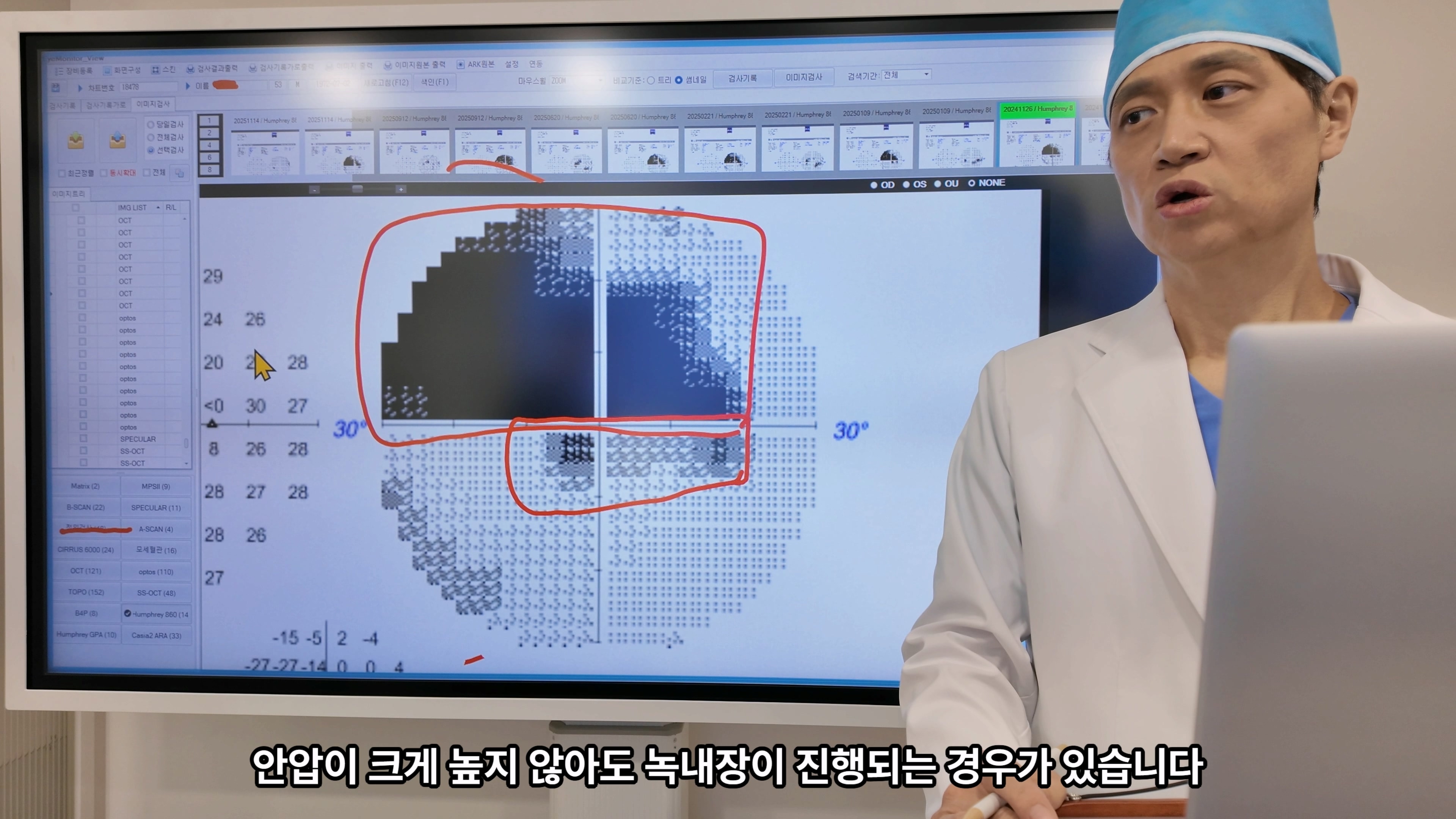 안압이 높지 않아도 진행된 녹내장, 50대 남성 우안 녹내장 수술 경과