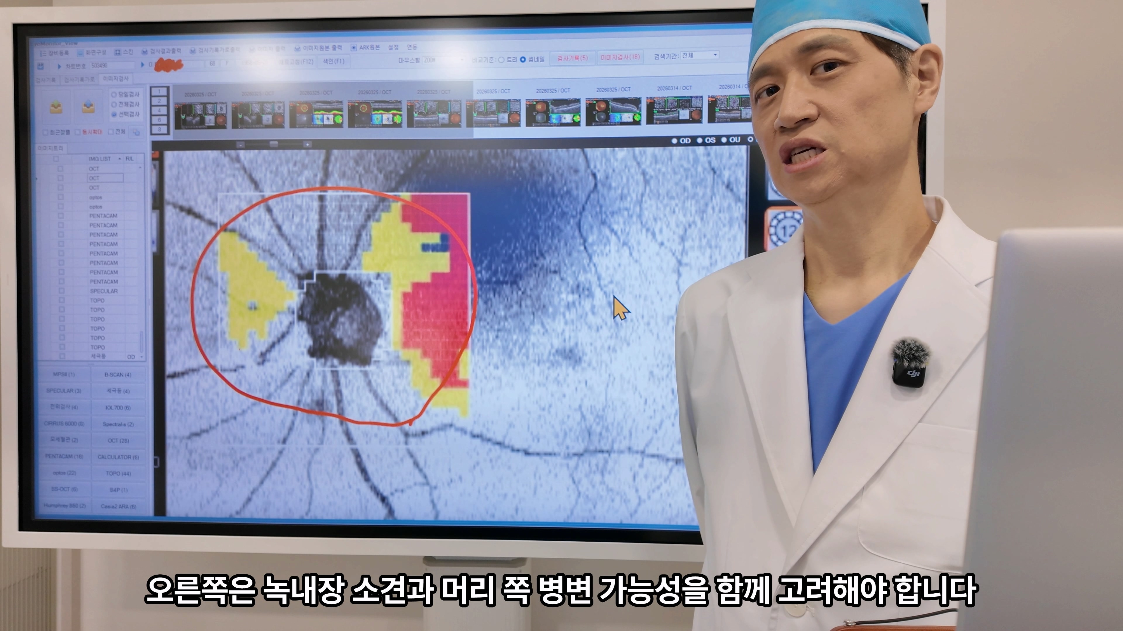 녹내장처럼 보이는 시야이상, 뇌혈관질환과 감별진단이 필요한 이유