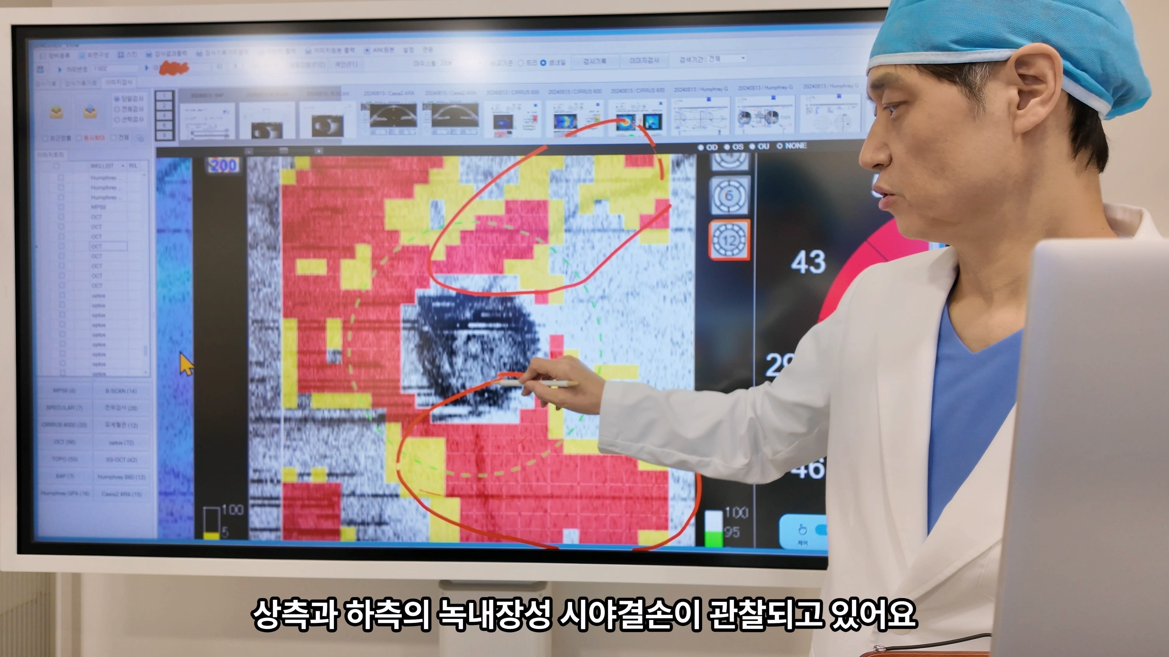 60대중반 녹내장재수술, 각막손상과 시야손상을 함께 봐야 하는 이유
