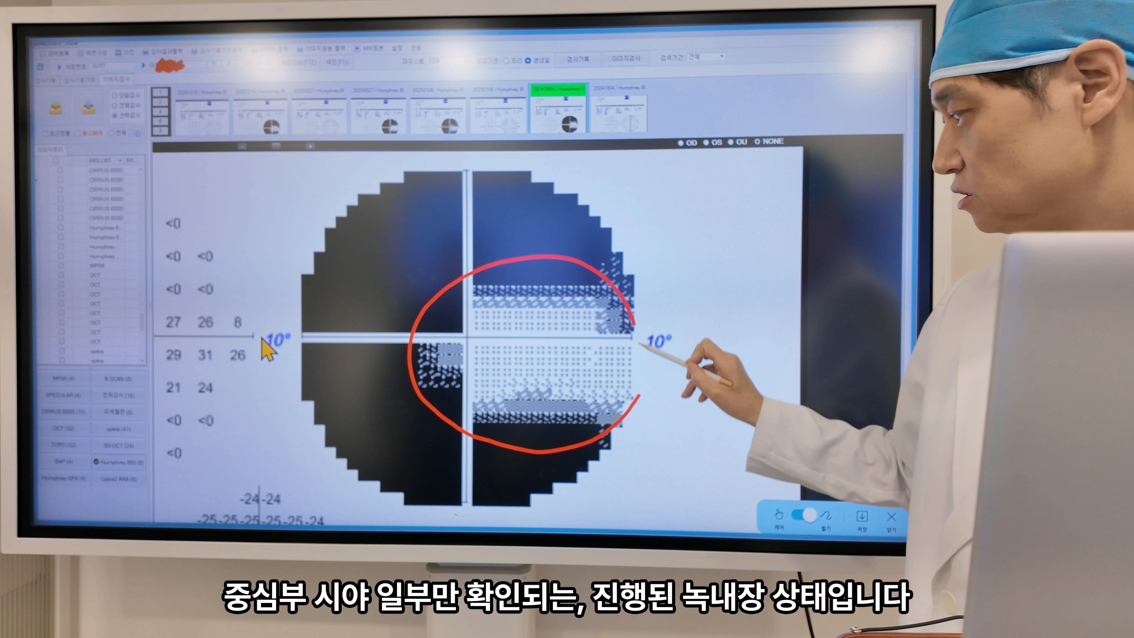 70대초반 우안 말기 녹내장 수술, 폐쇄각녹내장과 시신경손상 확인이 중요한 이유