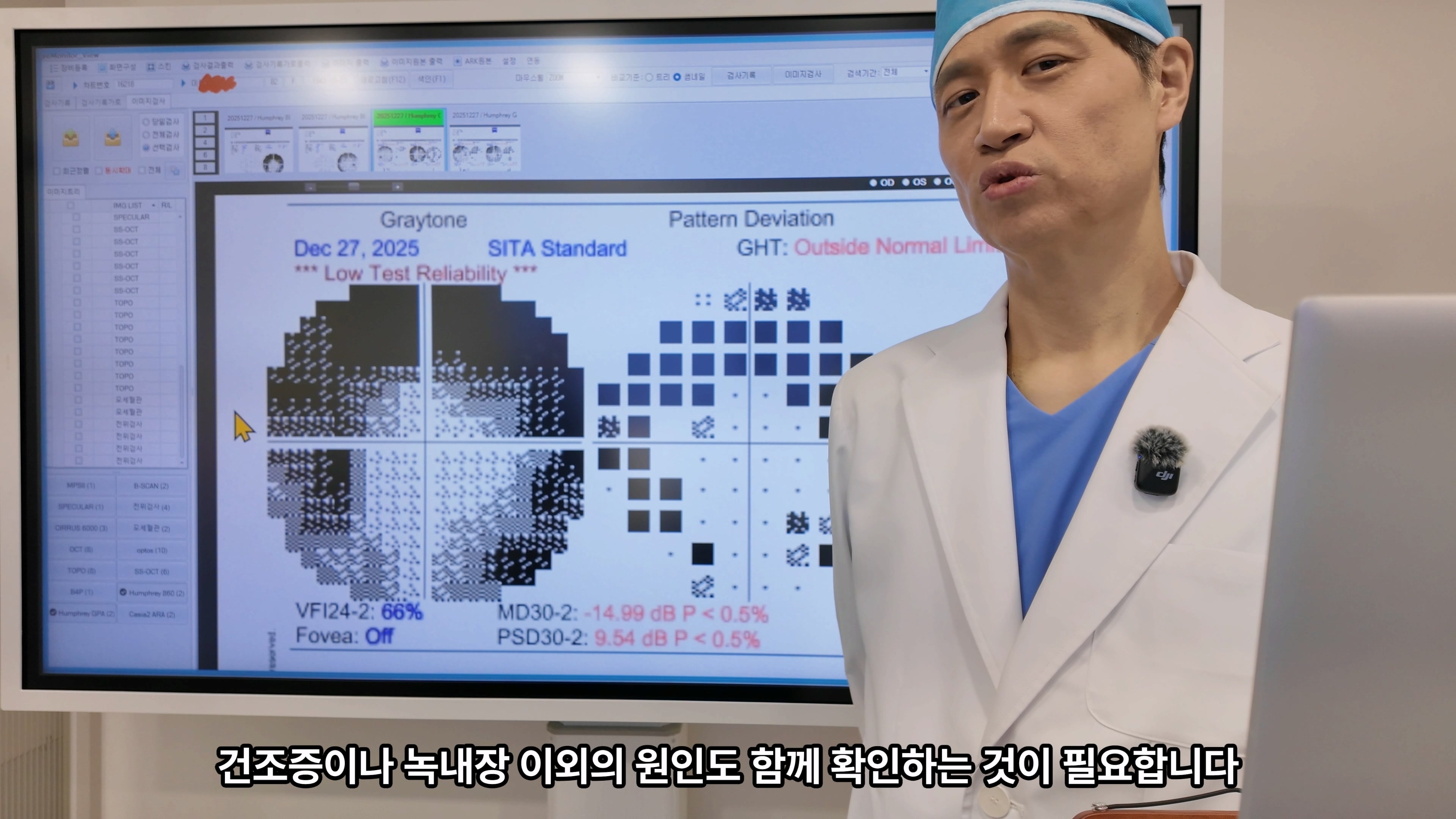 80대중반 양안녹내장, 녹내장시야검사 결과는 어떻게 해석해야 할까?