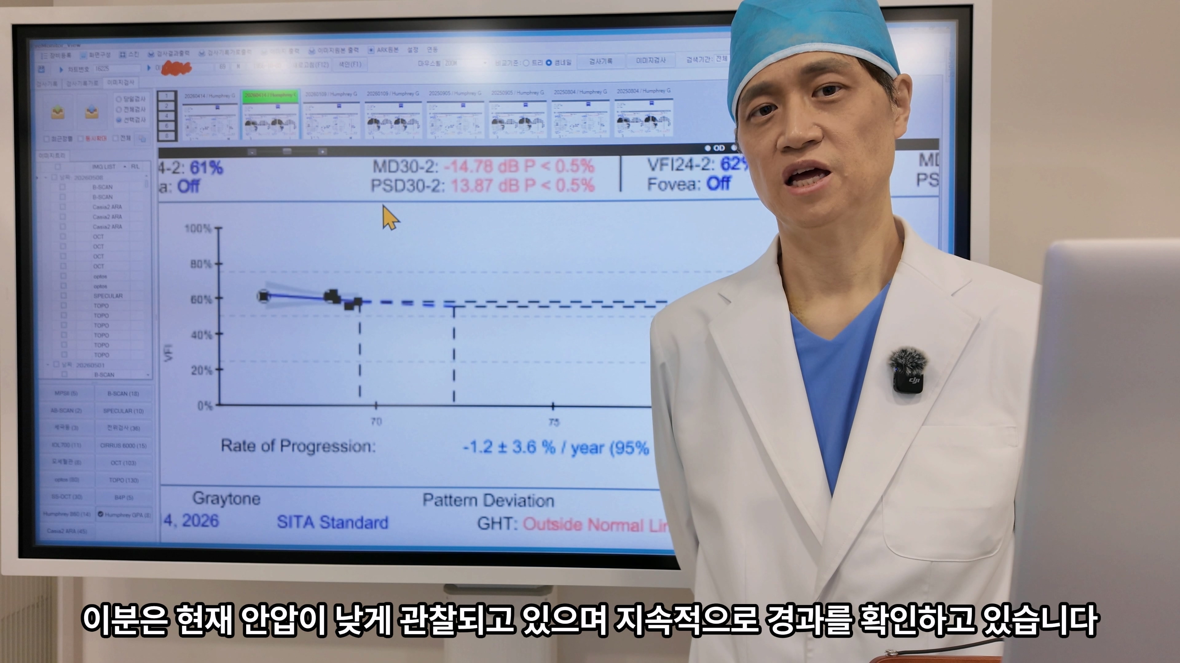 60대후반 녹내장, 안압상승 확인 후 우안섬유주절제술을 고려한 이유